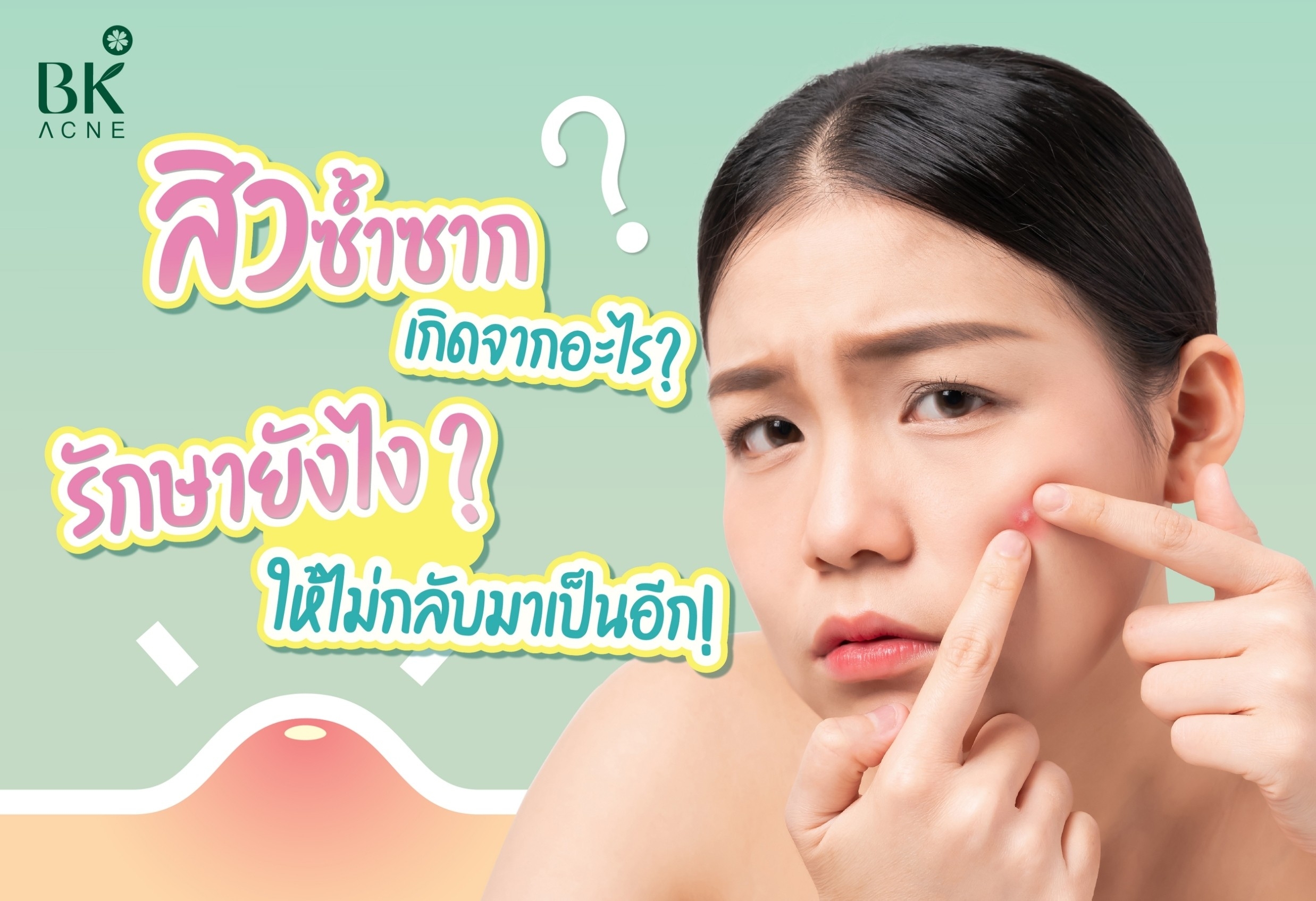 สิวซ้ำซากเกิดจากอะไร?  รักษายังไง? ให้ไม่กลับมาเป็นอีก!